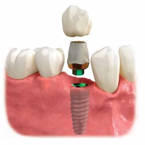 implantatum vélemény