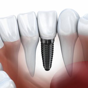 Fogászati implantáció, fogbeültetés