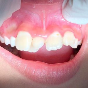 Fogágybetegség - Mosoly Dental Kozmetikai Fogászat